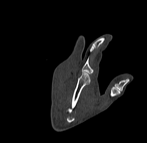 Base of 2nd metacarpal fracture (Radiopaedia 73741-84544 Coronal bone window 73).jpg