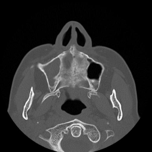 File:Base of skull chondrosarcoma (Radiopaedia 30410-31071 Axial bone window 6).jpg