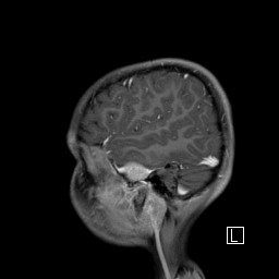 Base of skull rhabdomyosarcoma (Radiopaedia 32196-33142 J 14).jpg