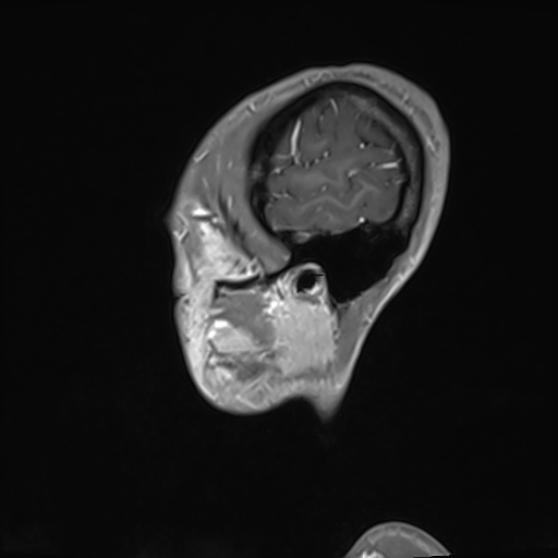 File:Basilar artery perforator aneurysm (Radiopaedia 82455-97733 G 133).jpg