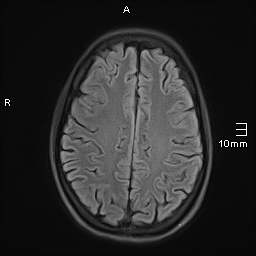 File:Basilar artery perforator aneurysm (Radiopaedia 82455-99523 Axial FLAIR 16).jpg