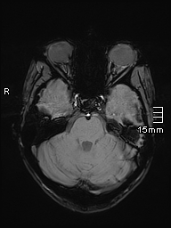 File:Basilar artery perforator aneurysm (Radiopaedia 82455-99523 Axial SWI 19).jpg