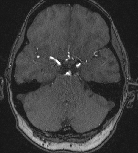 Basilar tip aneurysm (Radiopaedia 26504-26632 MRA 68).jpg