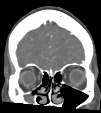 Basilar tip aneurysm with coiling (Radiopaedia 53912-60086 B 22).jpg