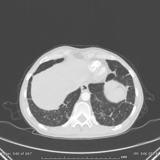 File:Behçet disease (Radiopaedia 44247-47889 Axial lung window 76).jpg