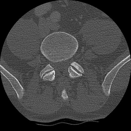 Benign post-traumatic pseudopneumoperitoneum (Radiopaedia 71199-81495 Axial bone window 264).jpg