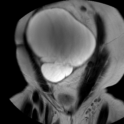 File:Benign seromucinous cystadenoma of the ovary (Radiopaedia 71065-81300 F 6).jpg
