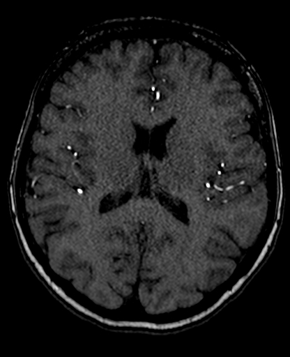 Berry aneurysm of the terminal internal carotid artery (Radiopaedia 88286-104918 Axial TOF 142).jpg