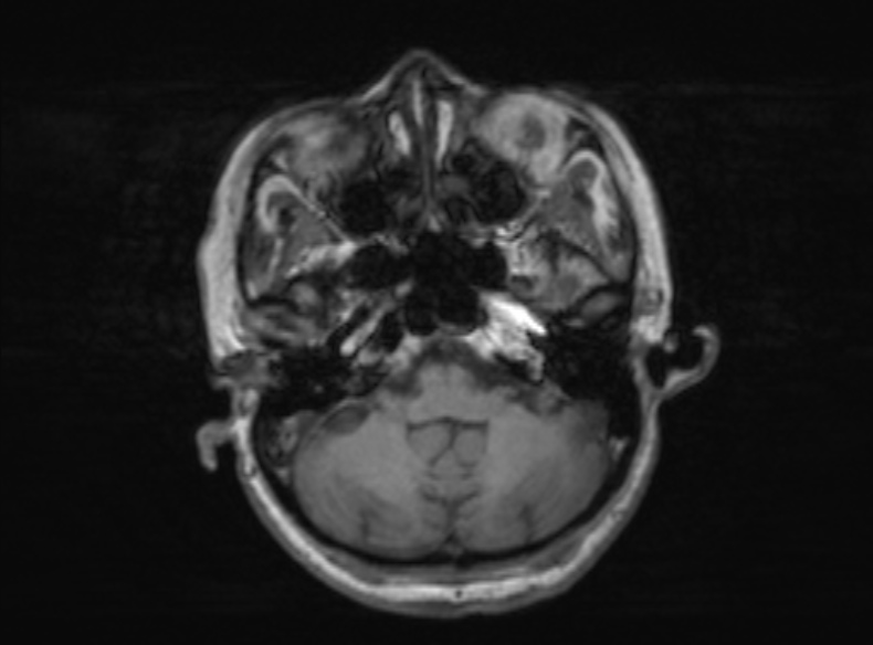 Bilateral PCA territory infarction - different ages (Radiopaedia 46200-51784 Axial T1 313).jpg