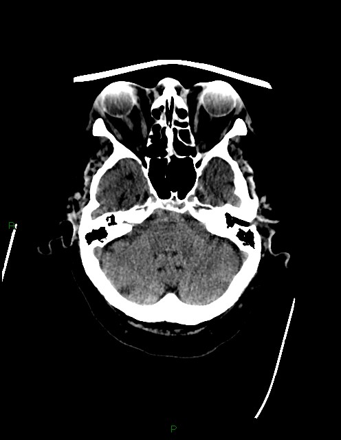 Bilateral acute middle cerebral artery territory infarcts (Radiopaedia 77319-89401 Axial non-contrast 19).jpg