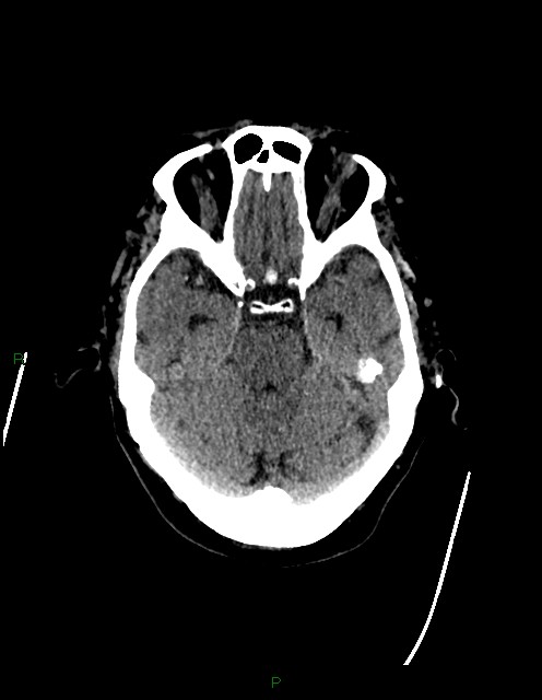 Bilateral acute middle cerebral artery territory infarcts (Radiopaedia 77319-89401 Axial non-contrast 28).jpg