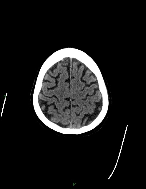 Bilateral acute middle cerebral artery territory infarcts (Radiopaedia 77319-89401 Axial non-contrast 75).jpg