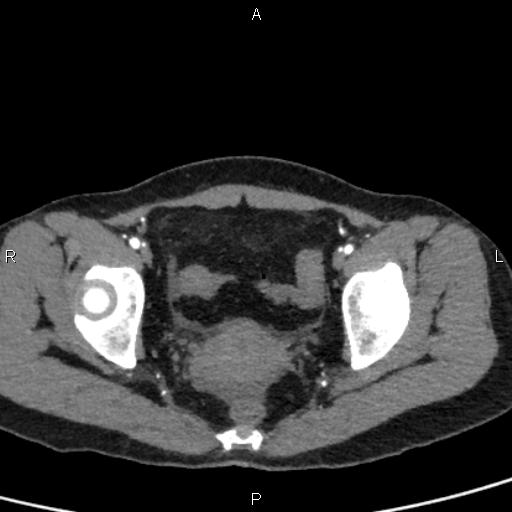 File:Bilateral adrenal gland hyperenhancement in pancreatitis (Radiopaedia 86642-102753 B 115).jpg