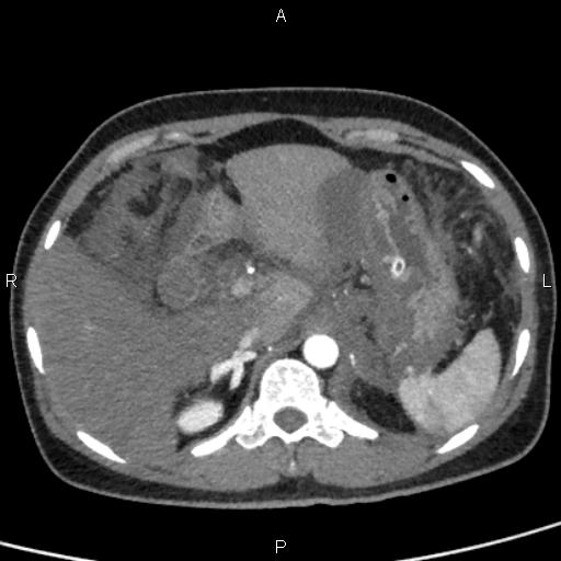 Bilateral adrenal gland hyperenhancement in pancreatitis (Radiopaedia 86642-102753 B 30).jpg
