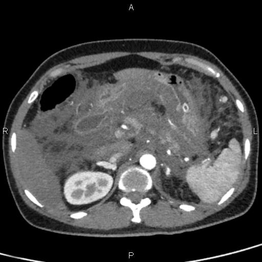 Bilateral adrenal gland hyperenhancement in pancreatitis (Radiopaedia 86642-102753 B 37).jpg