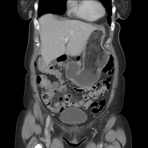 Bilateral adrenal granulocytic sarcomas (chloromas) (Radiopaedia 78375-91007 B 29).jpg