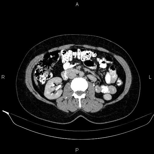 File:Bilateral adrenal myelolipoma (Radiopaedia 63058-71535 Axial C+ delayed 63).jpg