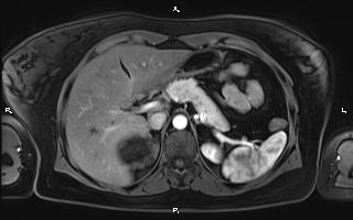 Bilateral adrenal myelolipoma (Radiopaedia 63058-71537 Axial T1 C+ fat sat 31).jpg