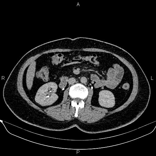 File:Bilateral benign adrenal adenomas (Radiopaedia 86912-103124 Axial C+ delayed 70).jpg