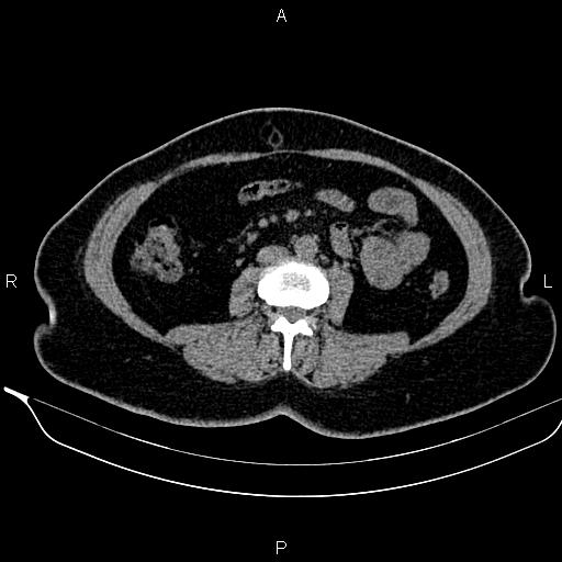 Bilateral benign adrenal adenomas (Radiopaedia 86912-103124 Axial non-contrast 63).jpg