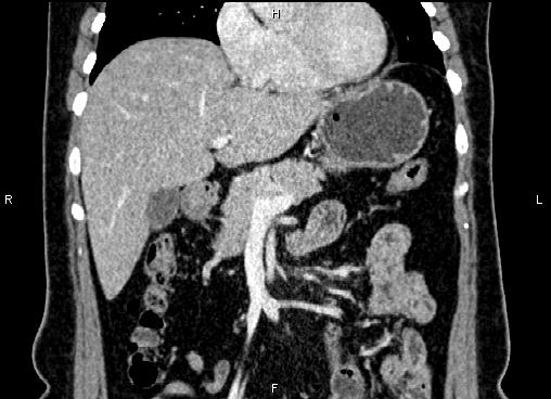Bilateral benign adrenal adenomas (Radiopaedia 86912-103124 D 20).jpg