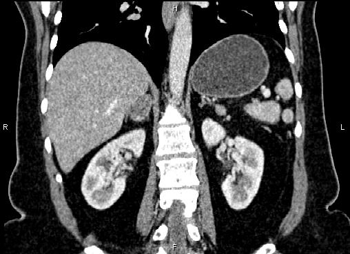 Bilateral benign adrenal adenomas (Radiopaedia 86912-103124 D 40).jpg