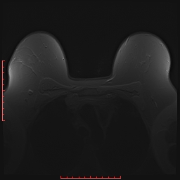 File:Bilateral breast implant rupture (Radiopaedia 24761-25027 PASTA 3).jpg
