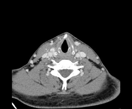 Bilateral carotid body tumors (Radiopaedia 61841-69870 Axial Post contrast 78).jpg