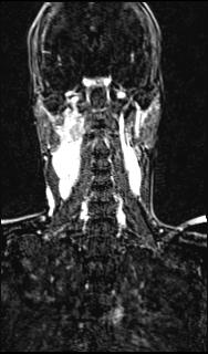 Bilateral carotid body tumors and right glomus jugulare tumor (Radiopaedia 20024-20060 MRA 106).jpg