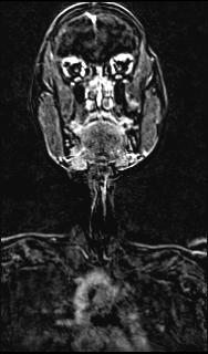 Bilateral carotid body tumors and right glomus jugulare tumor (Radiopaedia 20024-20060 MRA 76).jpg