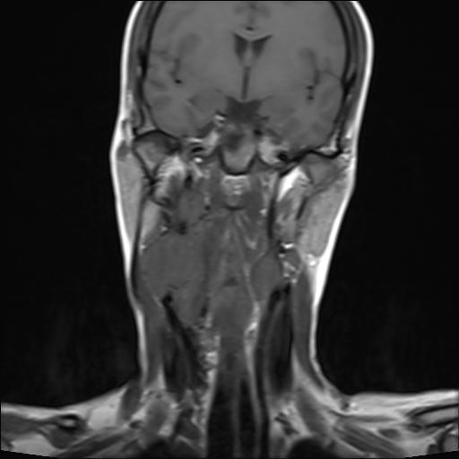 File:Bilateral carotid body tumors and right jugular paraganglioma (Radiopaedia 20024-20060 Coronal 8).jpg