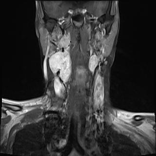 File:Bilateral carotid body tumors and right jugular paraganglioma (Radiopaedia 20024-20060 None 4).jpg