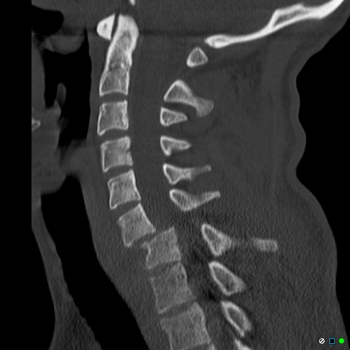 File:Bilateral cervical locked facets (Radiopaedia 21424-21364 Sagittal bone window 1).jpg