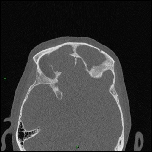 Bilateral frontal mucoceles (Radiopaedia 82352-96454 Axial bone window 112).jpg