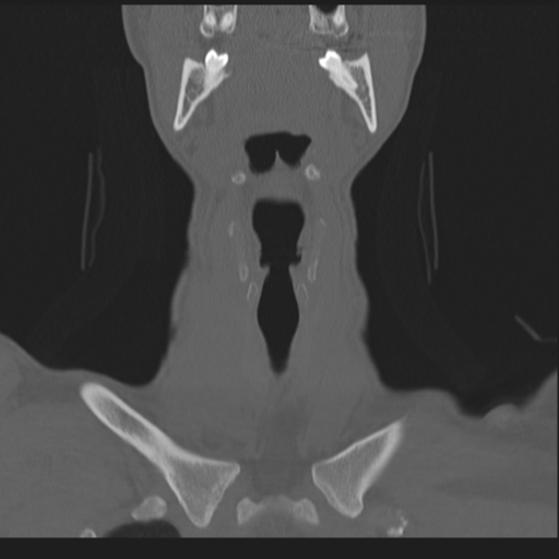 Bilateral locked facets (Radiopaedia 33850-35016 Coronal bone window 18).png