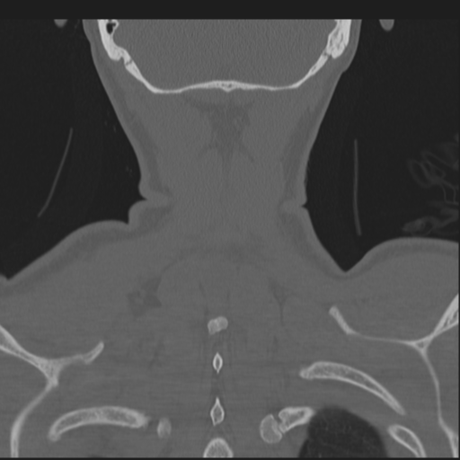Bilateral locked facets (Radiopaedia 33850-35016 Coronal bone window 80).png