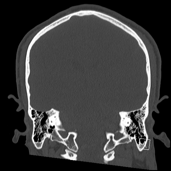 Bilateral occipital condyle fracture (type 2) (Radiopaedia 87675-104089 Coronal bone window 85).jpg
