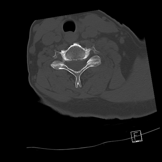 Bilateral occipital condyle fractures (type 3) (Radiopaedia 87672-104086 Axial bone window 57).jpg