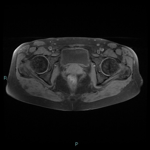 File:Bilateral ovarian fibroma (Radiopaedia 44568-48293 Axial T1 fat sat 22).jpg