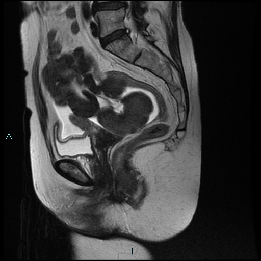 File:Bilateral ovarian fibroma (Radiopaedia 44568-48293 Sagittal T2 16).jpg