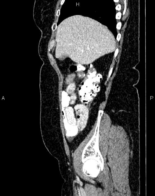 Bilateral ovarian serous cystadenocarcinoma (Radiopaedia 86062-101989 E 13).jpg