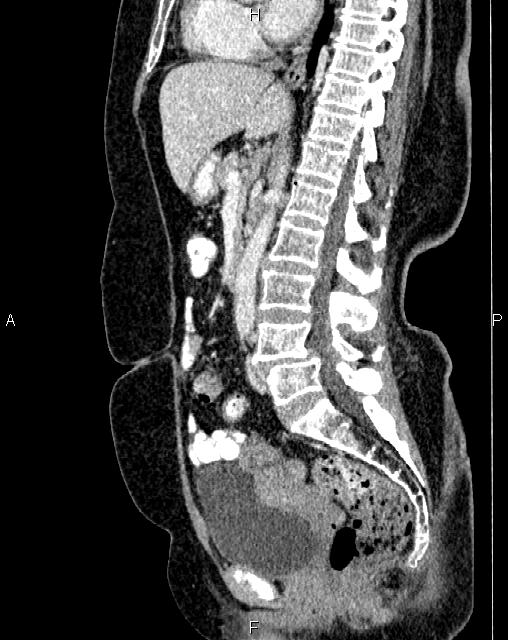 Bilateral ovarian serous cystadenocarcinoma (Radiopaedia 86062-101989 E 42).jpg