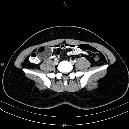 File:Bilateral ovarian teratoma (Radiopaedia 83131-97503 Axial With contrast 12).jpg