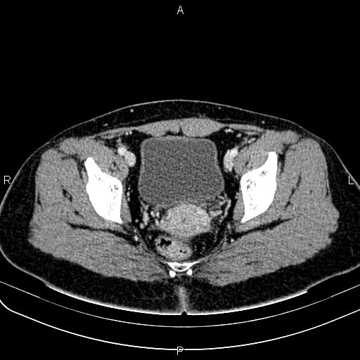 File:Bilateral ovarian teratoma (Radiopaedia 83131-97503 Axial With contrast 56).jpg