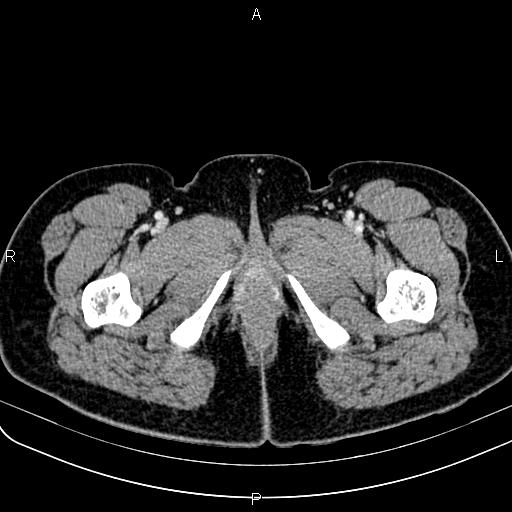 File:Bilateral ovarian teratoma (Radiopaedia 83131-97503 Axial With contrast 91).jpg