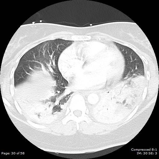 Bilateral pulmonary emboli with Hampton hump sign (Radiopaedia 54070-60246 Axial lung window 30).jpg