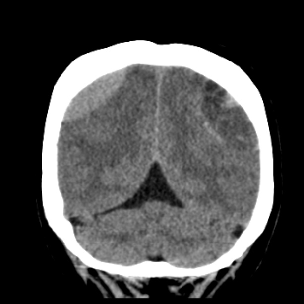 Bilateral subdural hemorrhages (Radiopaedia 26588-26732 Coronal non-contrast 47).jpg