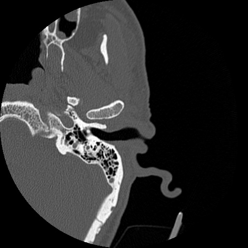 Bilateral temporal bone fractures (Radiopaedia 29482-29970 D 49).jpg