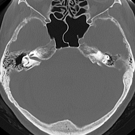 File:Bilateral tympanoplasty (Radiopaedia 16947-16664 Axial bone window 8).jpg