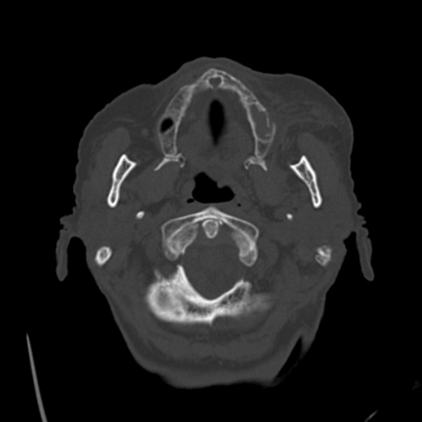 Biparietal osteodystrophy (Radiopaedia 46109-50463 bone window 7).jpg